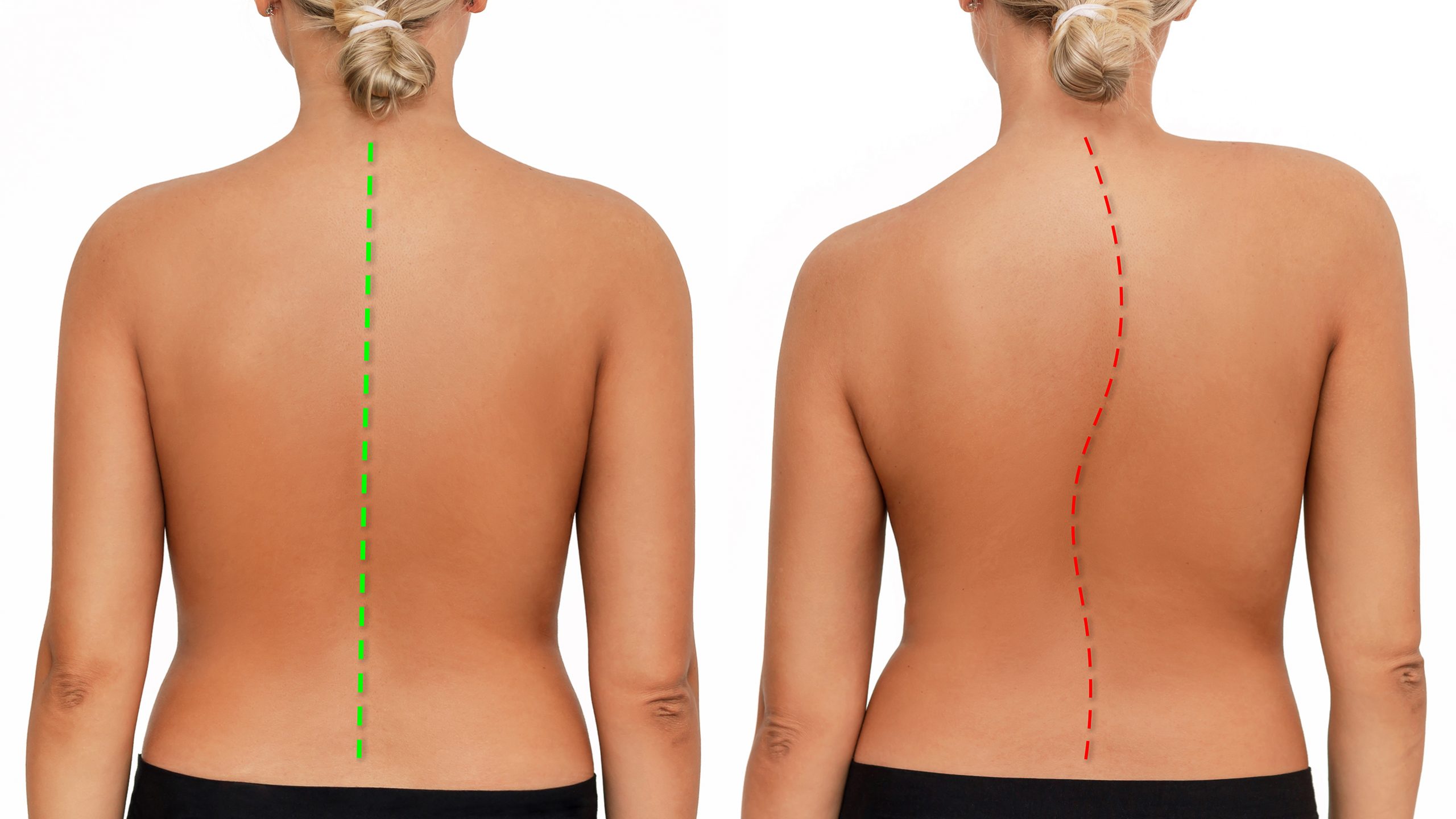 Scoliosis - photo of young woman with curved spine and straight spine