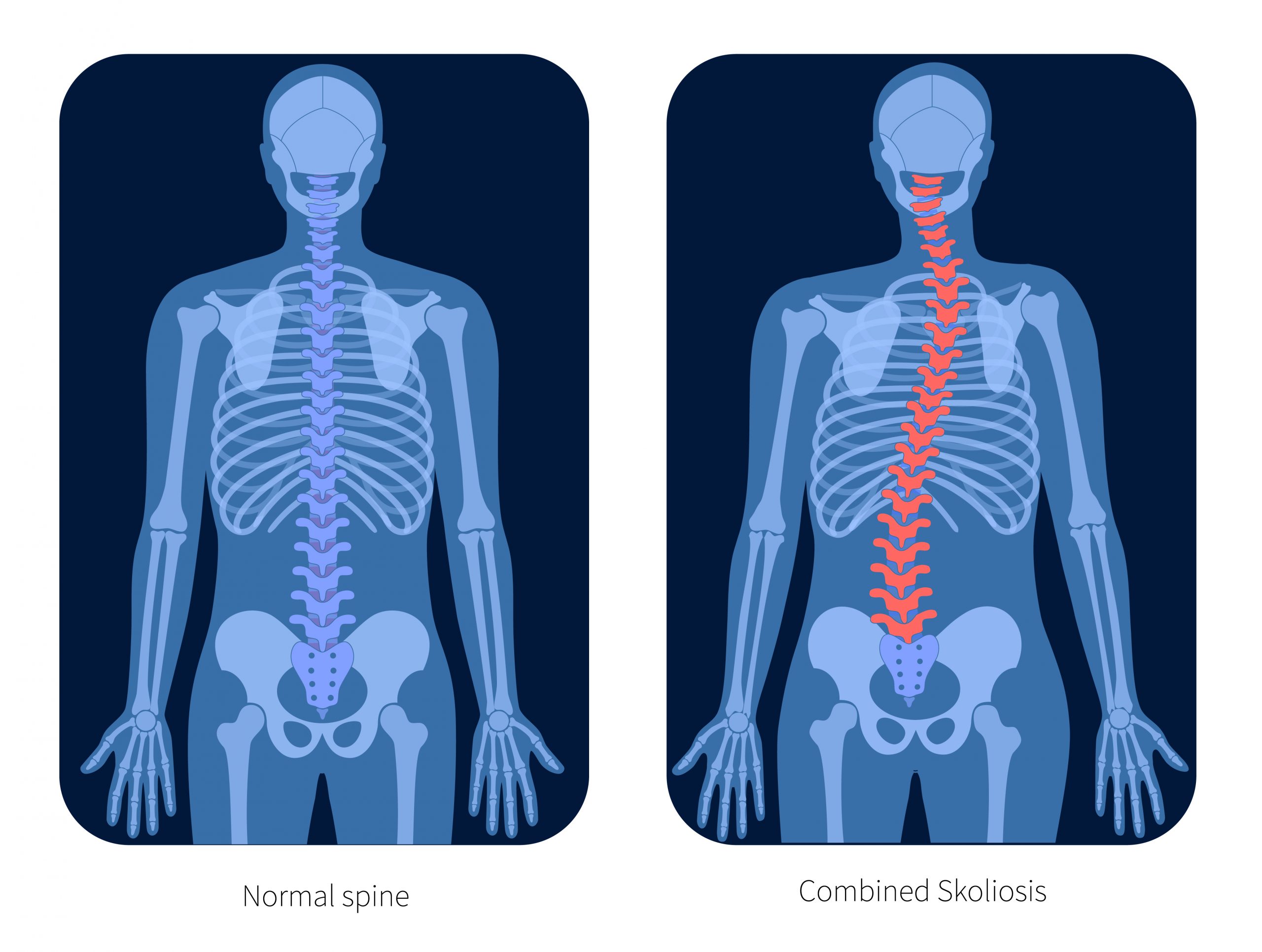 Types of scoliosis of spine infographics with set of isolated spine curvature images on blank background vector illustration